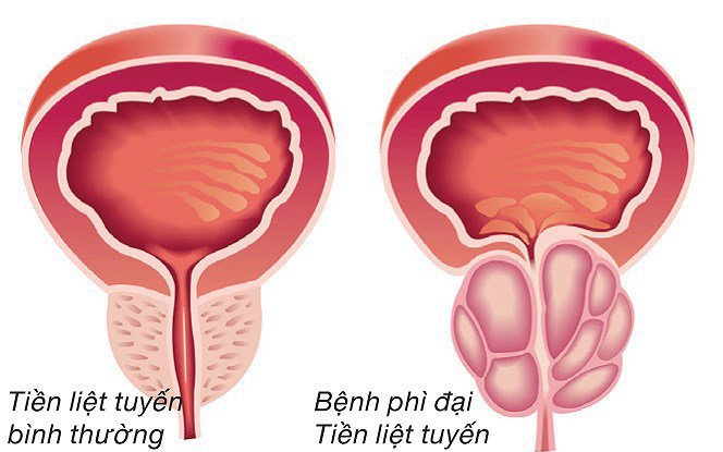 Bài thuốc đông y hỗ trợ điều trị phì đại tiền liệt tuyến