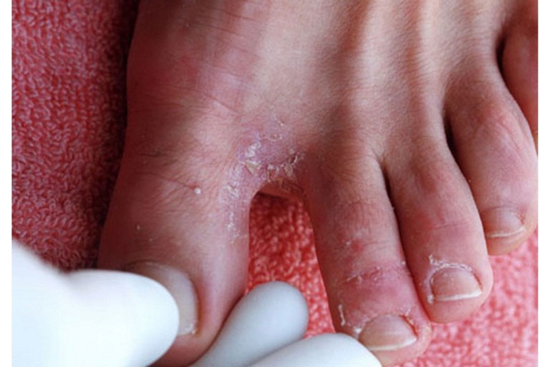 3 bệnh nấm da mùa hè thường gặp và biện pháp điều trị - Ảnh 3.