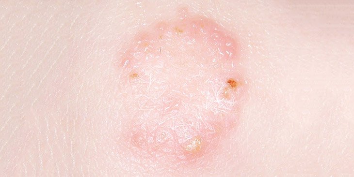3 bệnh nấm da mùa hè và biện pháp điều trị