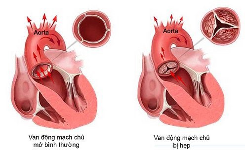 Hẹp van động mạch chủ và các lựa chọn điều trị