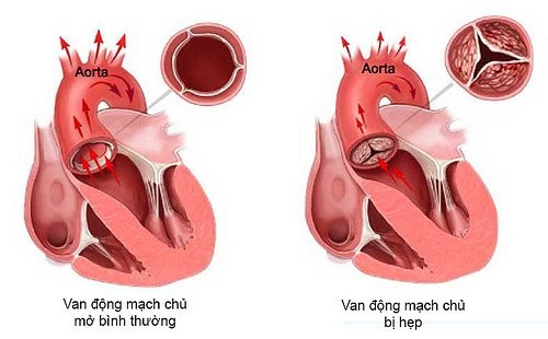 Hẹp van động mạch chủ và các lựa chọn điều trị - Ảnh 1.