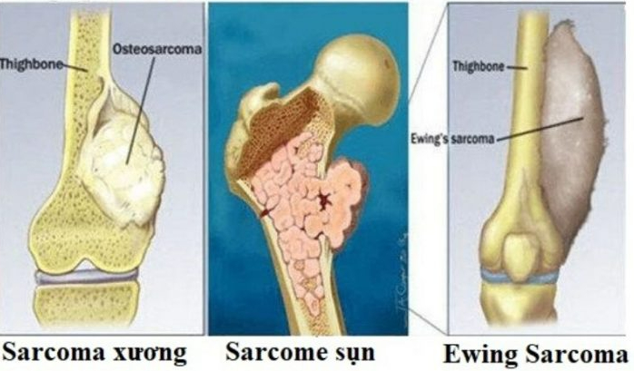 Ung thư xương nguyên phát - Phát hiện và điều trị