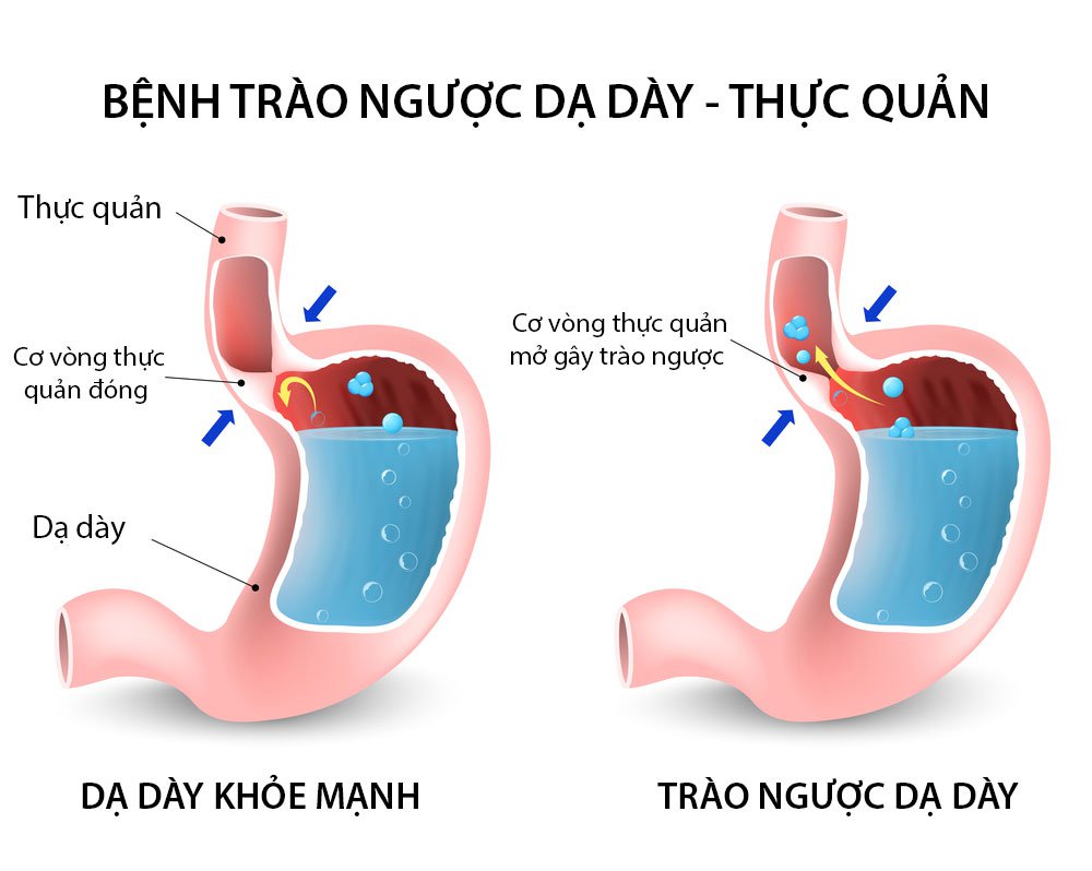 1. Tổng Quan Về Trào Ngược Dạ Dày