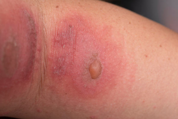 Nhấn vào ảnh để phóng to Coi chừng viêm da do tiếp xúc với côn trùng ngày mưa - Ảnh 2.