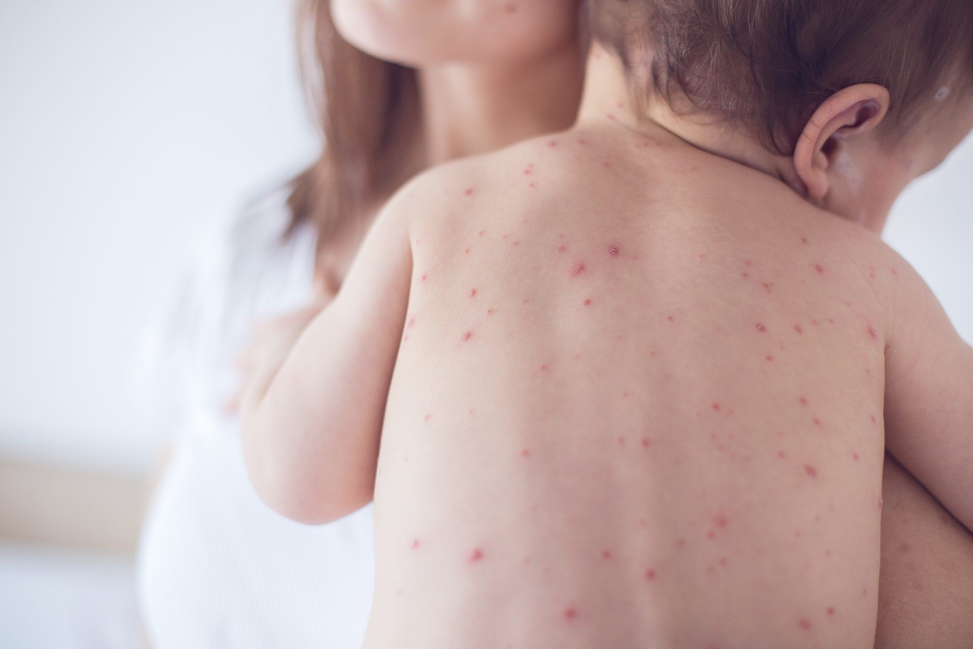 Sốt xuất huyết ở trẻ em phân biệt với sốt do bệnh khác