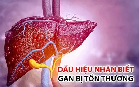 7 biểu hiện cho thấy gan bị bệnh và cách xử trí