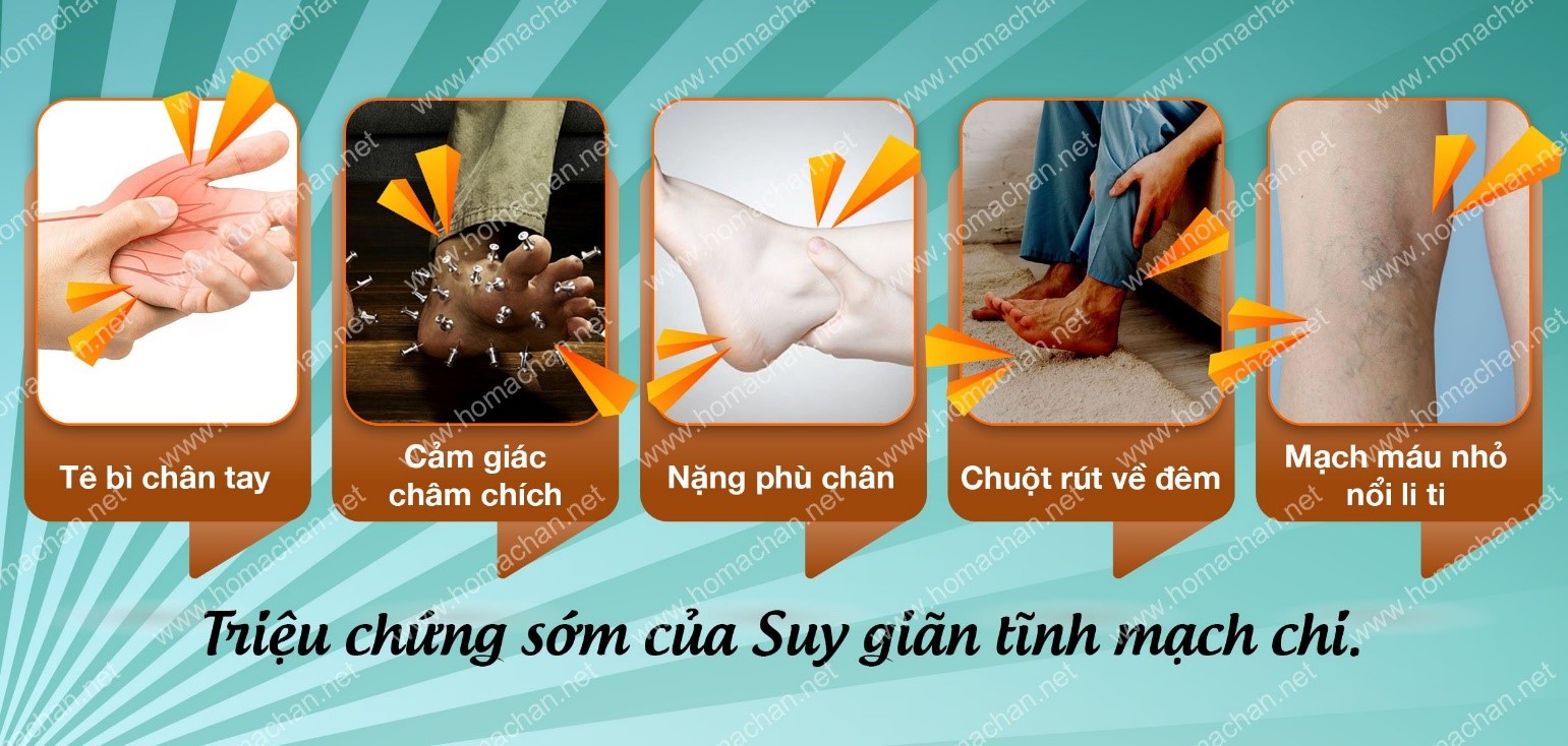Chuột rút về đêm - Dấu hiệu của suy giãn tĩnh mạch - Ảnh 1.