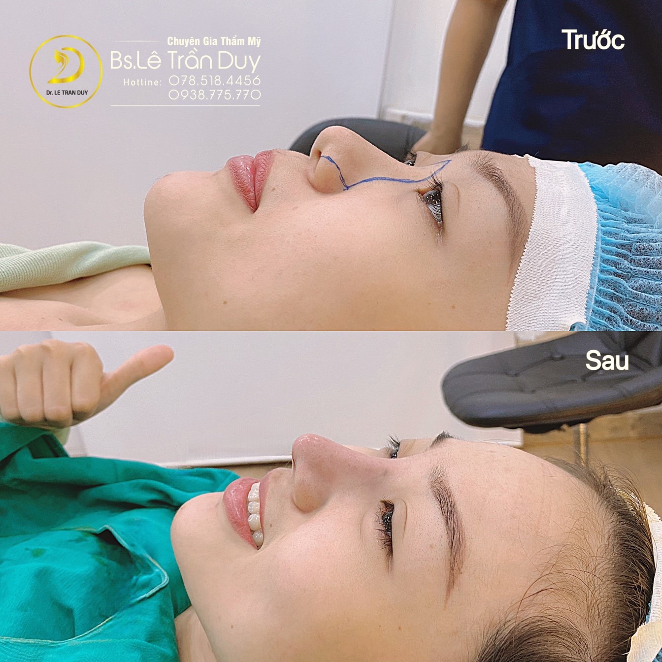 Nâng mũi sụn tự thân tuyệt đẹp ở bác sĩ tài năng - Ảnh 2. Nâng mũi sụn tự thân tuyệt đẹp ở bác sĩ tài năng - Ảnh 2.