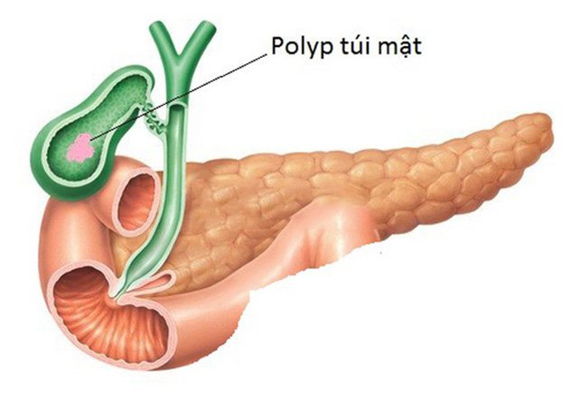 Cẩn trọng polyp túi mật có nguy cơ chuyển thành ung thư - Ảnh 1.