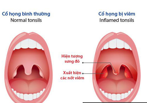 Viêm họng mạn tính có lây sang viêm xoang?