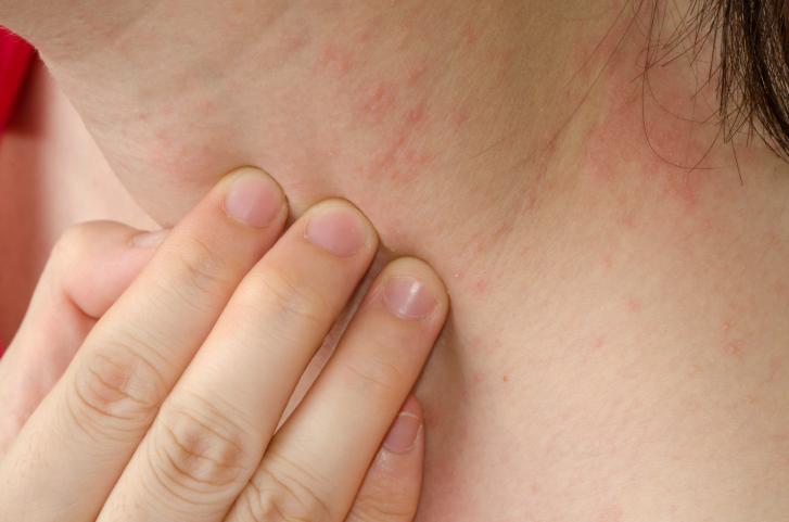 Mẩn ngứa ở trẻ cần xử trí như thế nào?- Ảnh 2. Mẩn ngứa ở trẻ cần xử trí như thế nào?- Ảnh 2.