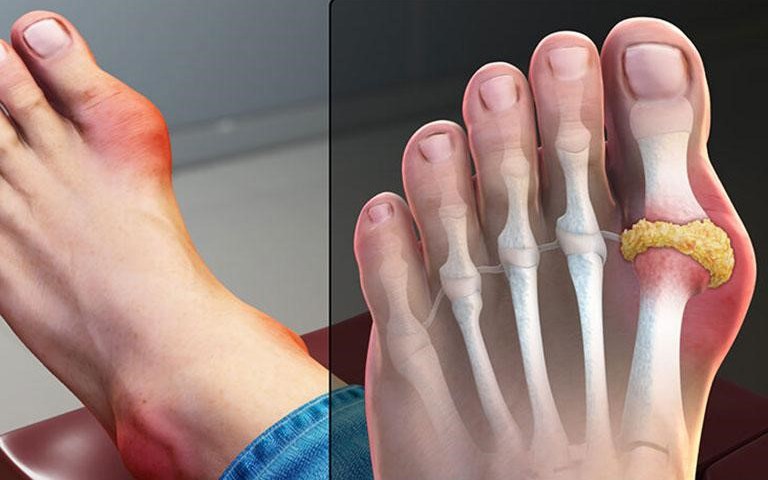 Bệnh gút (gout) là gì? Triệu chứng, chẩn đoán và cách điều trị