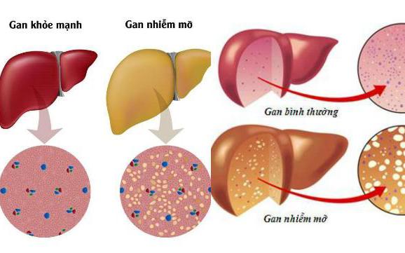 Cách ngăn ngừa gan nhiễm mỡ ở người bệnh đái tháo đường