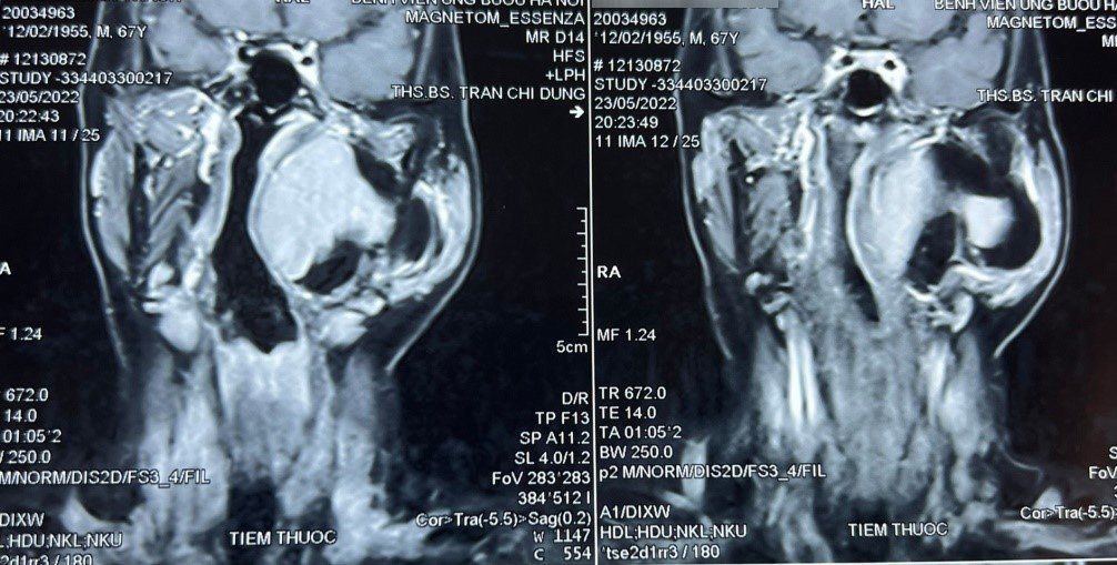 Sưng phồng vùng mang tai trái, nam bệnh nhân không ngờ mắc khối u hiếm gặp, phức tạp vùng đầu cổ - Ảnh 1.