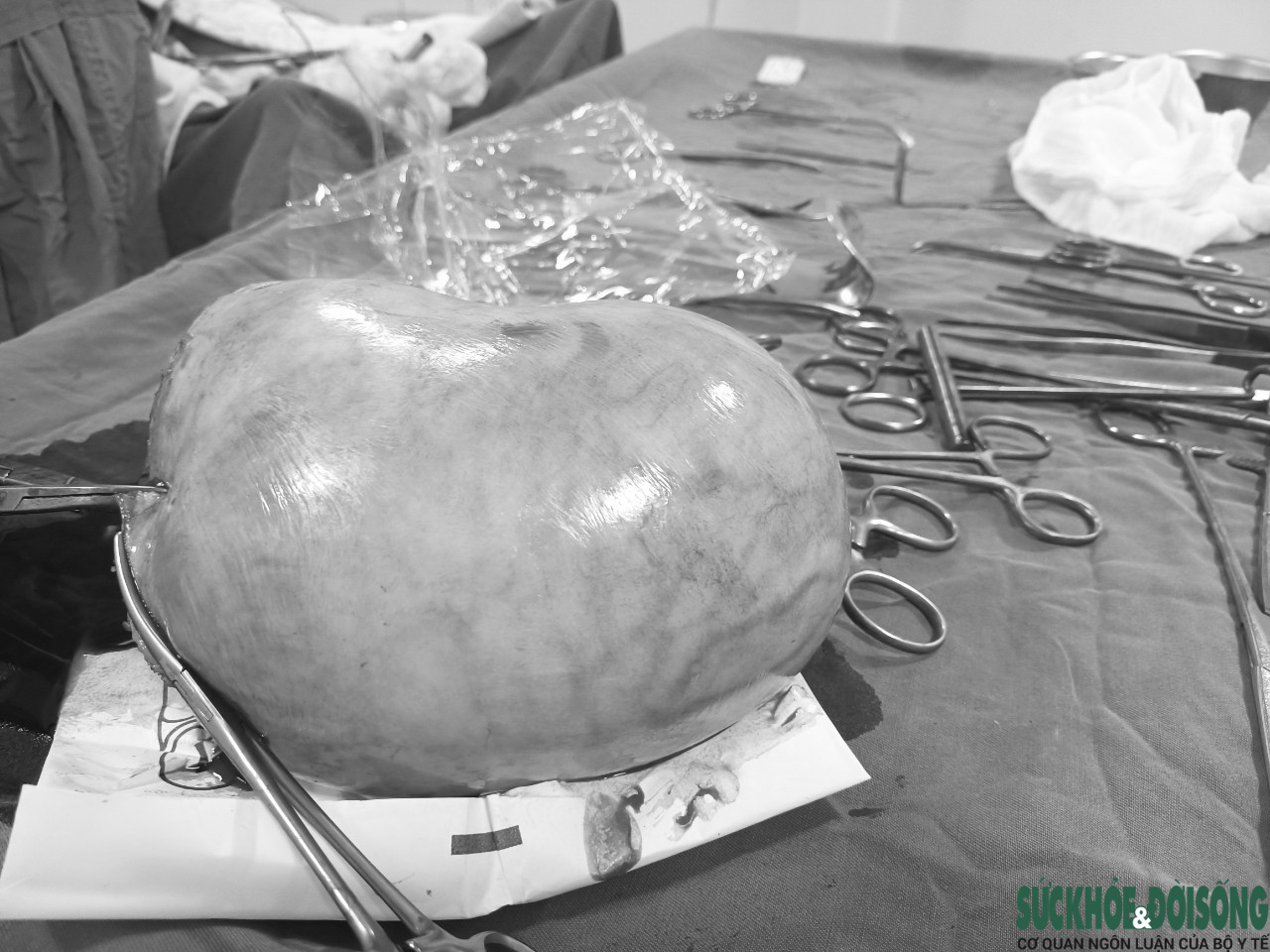 TTYT huyện miền núi phẫu thuật thành công khối u xơ tử cung “khủng” như thai 5 tháng - Ảnh 2.