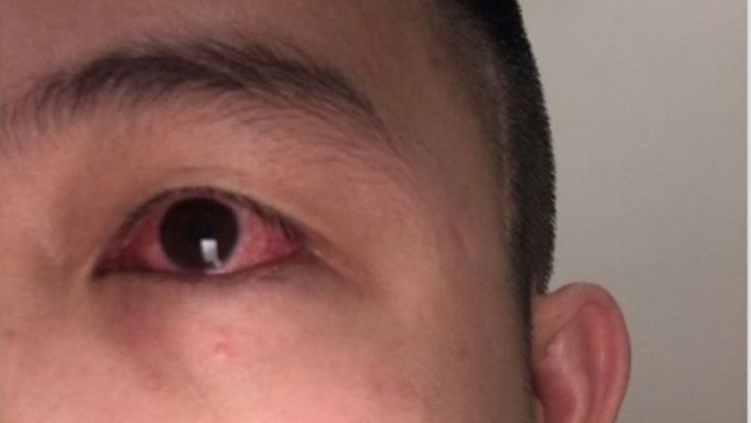 Bị đau mắt có nên dùng nước lá trầu không để rửa mắt?
