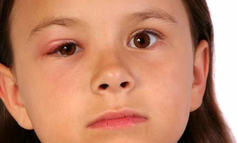 Nhận biết và điều trị chắp, lẹo mắt tránh nguy cơ tái phát