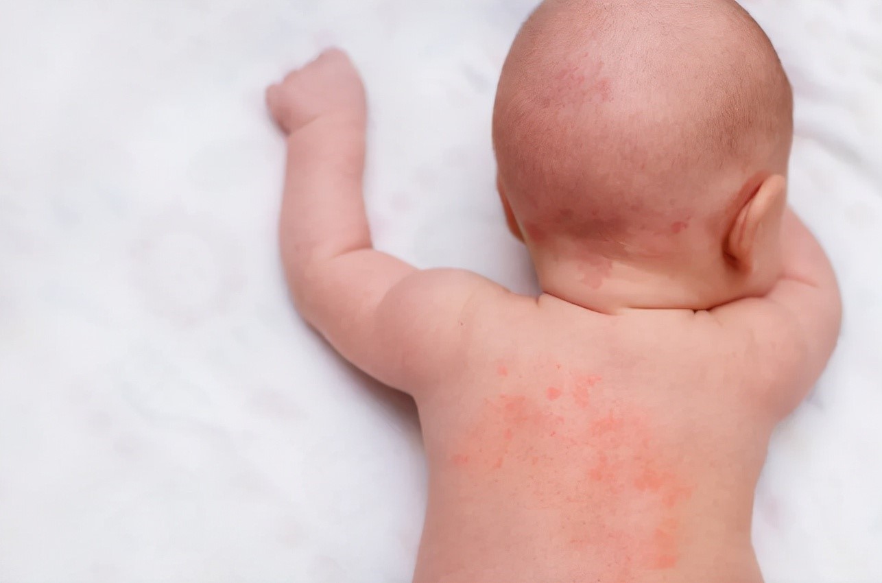 Góc mẹ bỉm sữa: Tâm sự chuyện trẻ bị rôm sảy ngày hè
