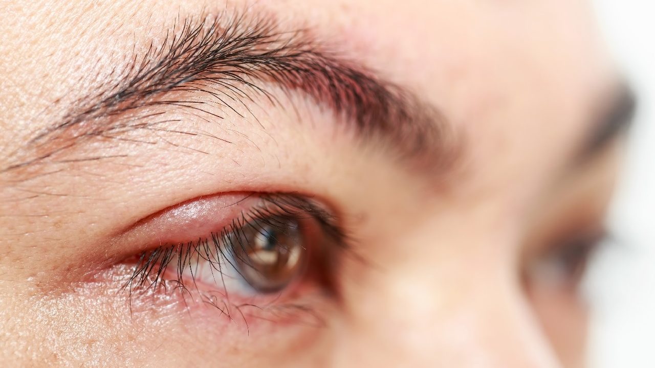 nhiễm trùng mắt 