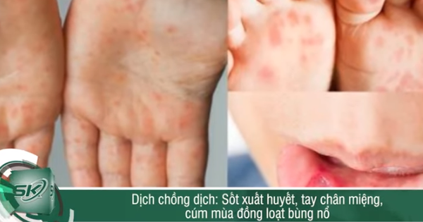 Nguy cơ dịch chồng dịch khi sốt xuất huyết, tay chân miệng, cúm mùa đồng loạt bùng nổ