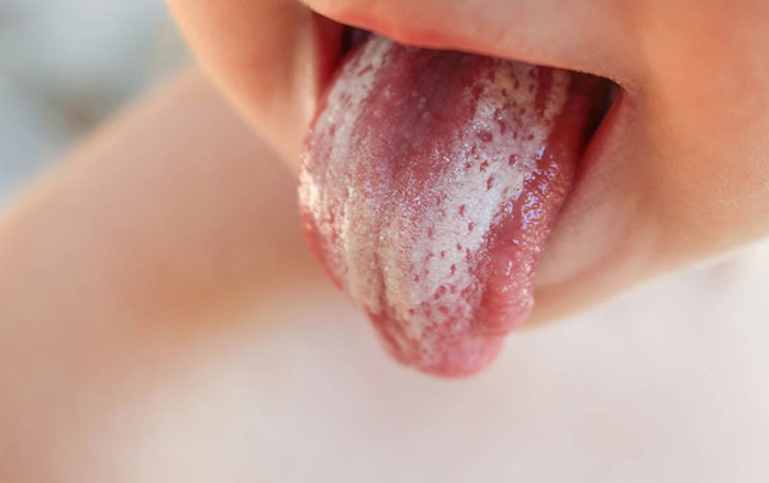 Nấm lưỡi, miệng ở trẻ: Xử trí và phòng ngừa thế nào?