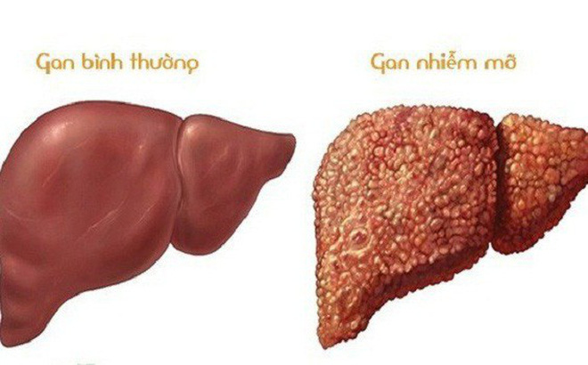 Gan nhiễm mỡ có nguy hiểm không nếu trẻ em mắc phải?