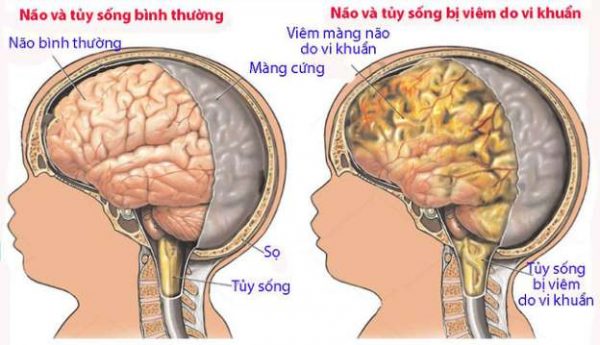 Các dấu hiệu sớm bệnh viêm màng não ở trẻ cha mẹ đừng bỏ qua - Ảnh 1.