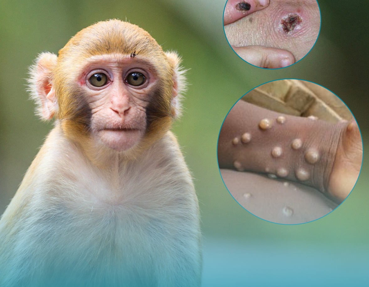 Nóng: Bộ Y tế ban hành hướng dẫn chẩn đoán, điều trị và phòng bệnh đậu mùa khỉ ở người - Ảnh 2.