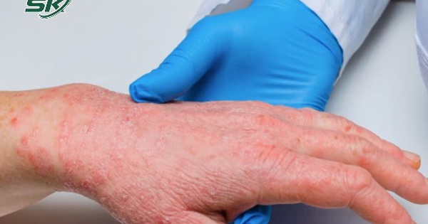 Bệnh đậu mùa khỉ: Hiểu đúng về vaccine phòng ngừa và thuốc kháng virus