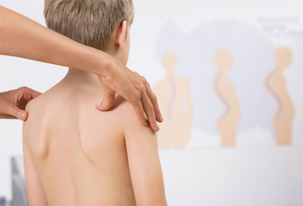 Những yếu tố nguy cơ gây gù vẹo cột sống ở trẻ em cha mẹ cần biết - Ảnh 5.