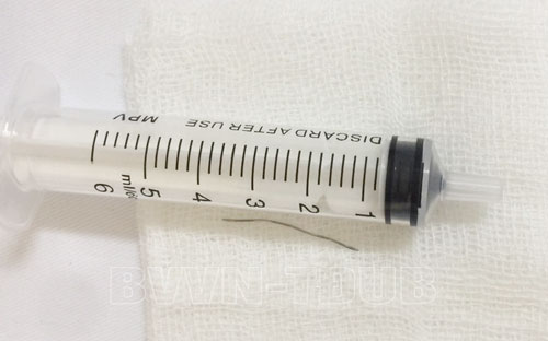 Đoạn dây thép được lấy ra khỏi cổ họng của người bệnh Đoạn dây thép được lấy ra khỏi cổ họng của người bệnh