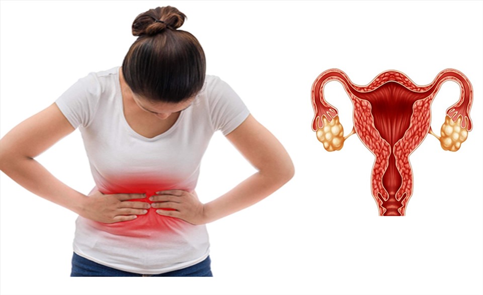 Hiện nay nguyên nhân buồng trứng đa nang vẫn chưa tìm được lý do chính xác Các nhà nghiên cứu cho rằng có yếu tố di truyền, chế độ ăn uống. Hiện nay nguyên nhân buồng trứng đa nang vẫn chưa tìm được lý do chính xác Các nhà nghiên cứu cho rằng có yếu tố di truyền, chế độ ăn uống.