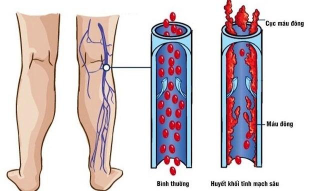 Khoảng 40% người trưởng thành mắc phải suy giãn tĩnh mạch, con số đáng báo động - Ảnh 2.