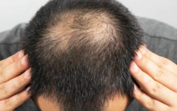 Đàn ông hói đầu có phải liên quan đến vấn đề sinh lý?