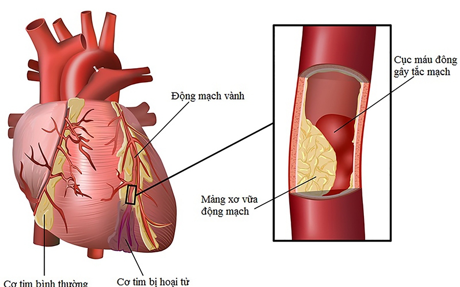 Cách nhận biết viêm cơ tim và phương pháp điều trị