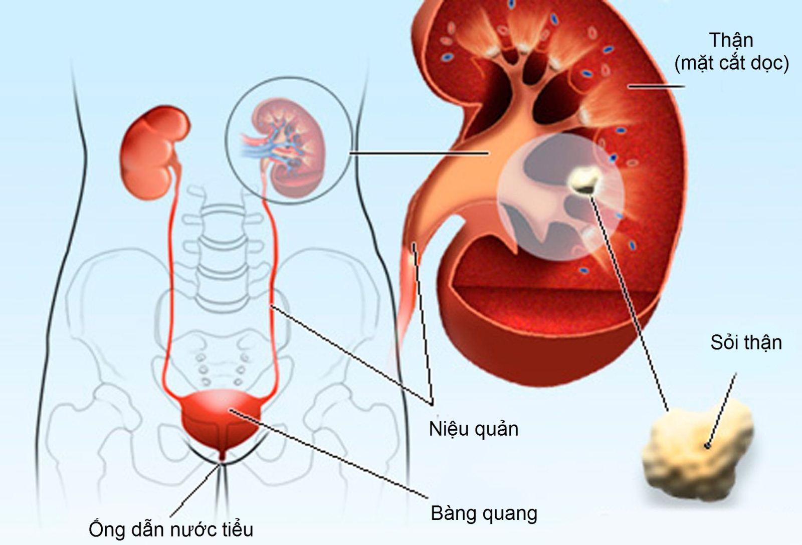 Sỏi tiết niệu ở trẻ: Phát hiện muộn có thể ảnh hưởng chức năng thận- Ảnh 2.