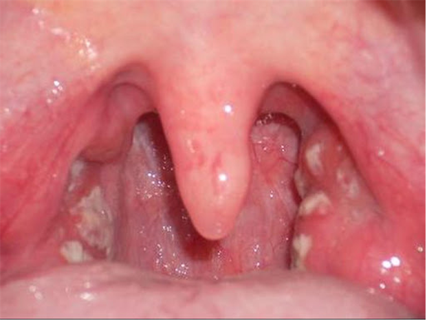 Nhận biết và phòng ngừa nấm họng