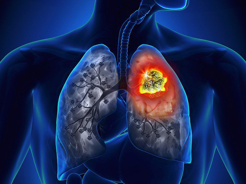 Ung thư phổi liệu có di truyền? - Ảnh 2.
