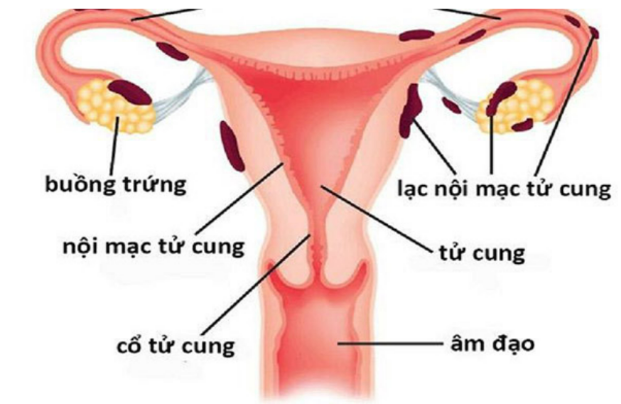 Lạc nội mạc tử cung