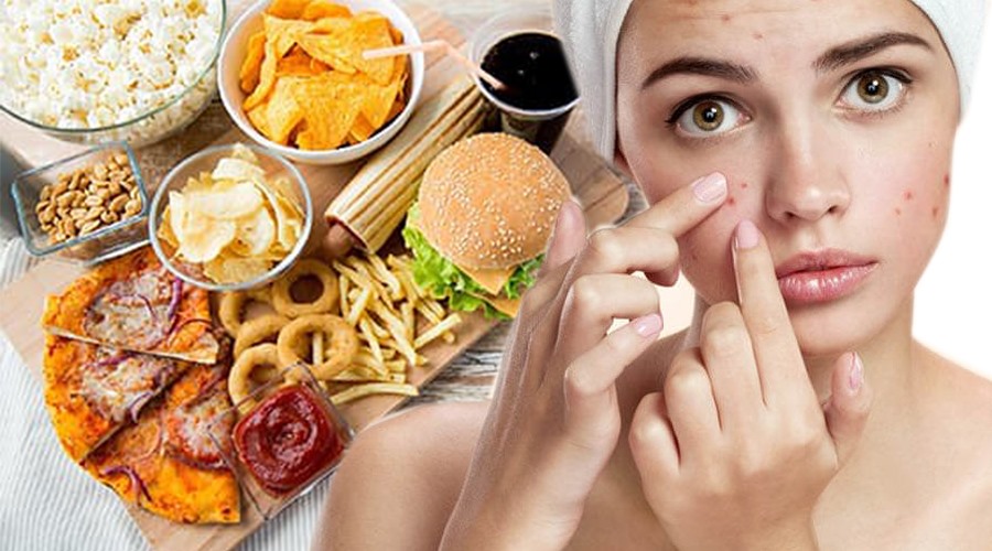 Ảnh hưởng của chế độ ăn đến việc hình thành mụn trứng cá.