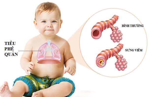 Viêm tiểu phế quản cấp ở trẻ em: Con đường lây nhiễm và trẻ nào dễ mắc - Ảnh 2.