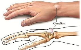 Bệnh bướu cổ tay và cách sử dụng