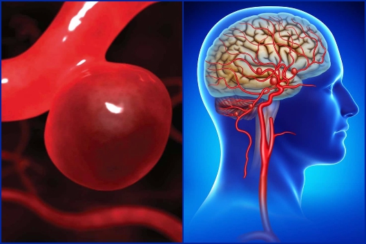 Phình mạch máu não cần được phát hiện và can thiệp sớm - Ảnh 1.