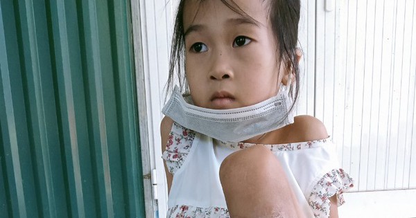 Không tiền điều trị, bé gái dân tộc Dao bị rắn độc cắn có nguy cơ mất chân vĩnh viễn