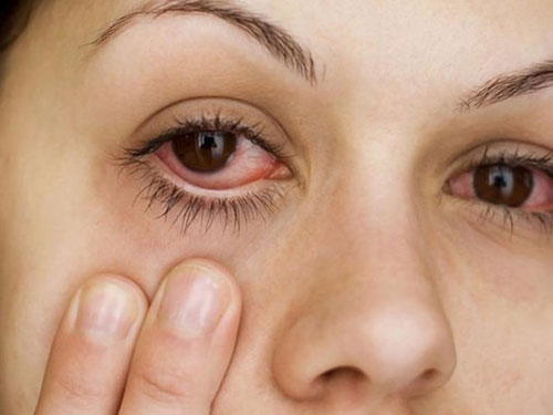 Mắt đỏ là dấu hiệu điển hình khi bạn bị dị ứng mắt