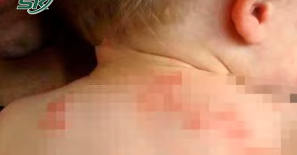 Báo động bệnh chốc lở lây lan mạnh khi trẻ tựu trường
