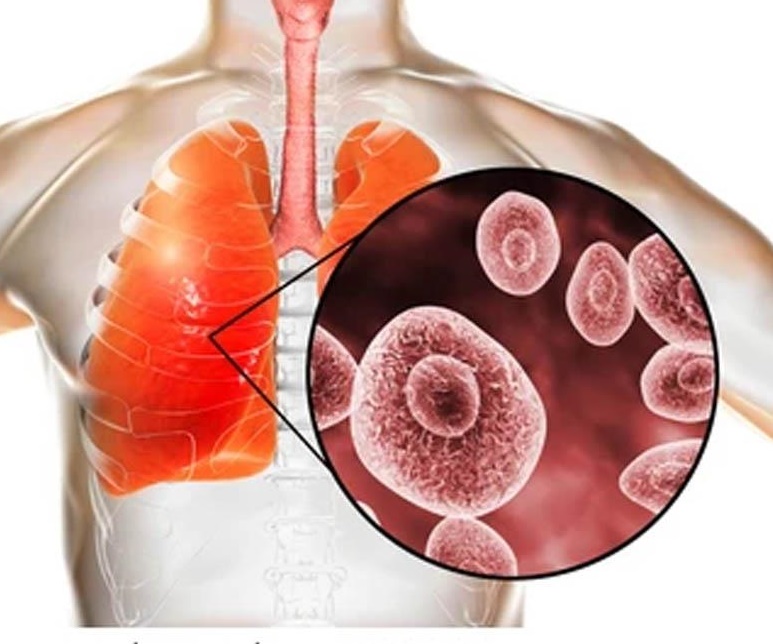 Bào tử nấm Aspergillus phát triển thành khối cầu nấm bên trong các hang phổi có sẵn