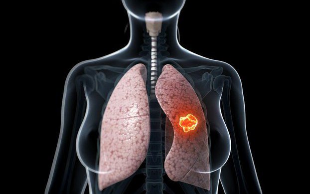 Biểu hiện sớm ung thư phổi ở giai đoạn đầu