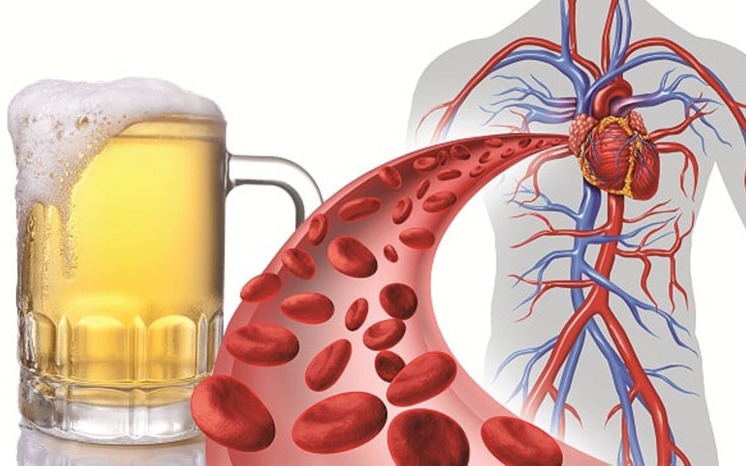 Vì sao rượu bia là "kẻ thù" với người bệnh tăng huyết áp?