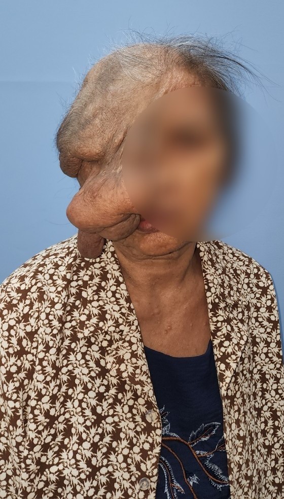 Cắt bỏ thành công khối u 1,5kg trên mặt cụ bà 73 tuổi - Ảnh 1.